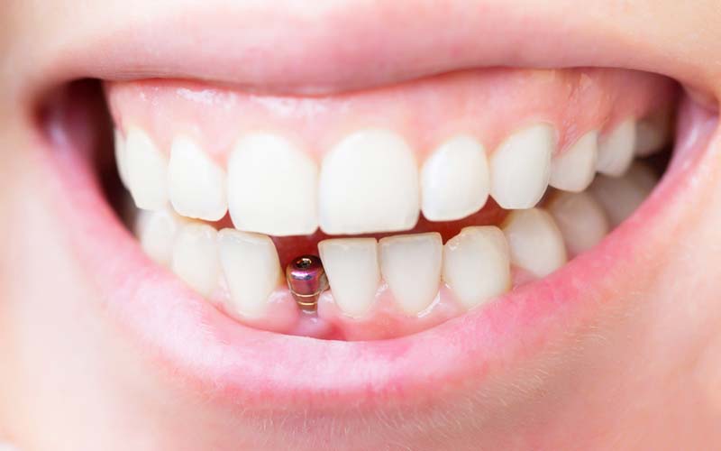 Какие бывают зубные имплантаты и как выбрать лучший вариант для вашей улыбки